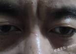 怎么治疗激光还是切除