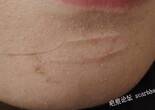 下頜處15年陳舊瘢痕