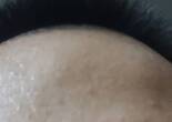 这种凹陷型的疤痕能不能去掉好烦啊
