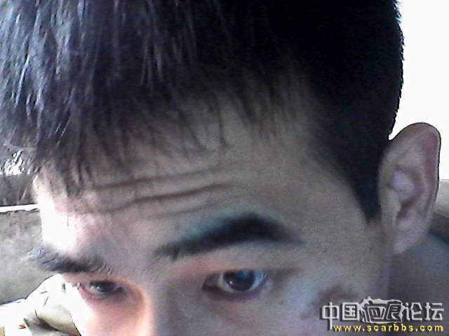 脸上碰伤，缝7针，是不是有色素沉降呀 