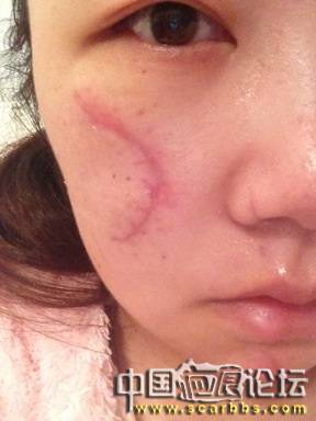 一场车祸改变了我！即将30天的新疤痕！求帮助！谢谢大家了 