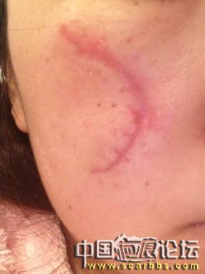 一场车祸改变了我！即将30天的新疤痕！求帮助！谢谢大家了 