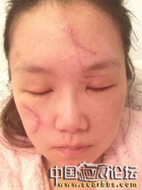 一场车祸改变了我！即将30天的新疤痕！求帮助！谢谢大家了 