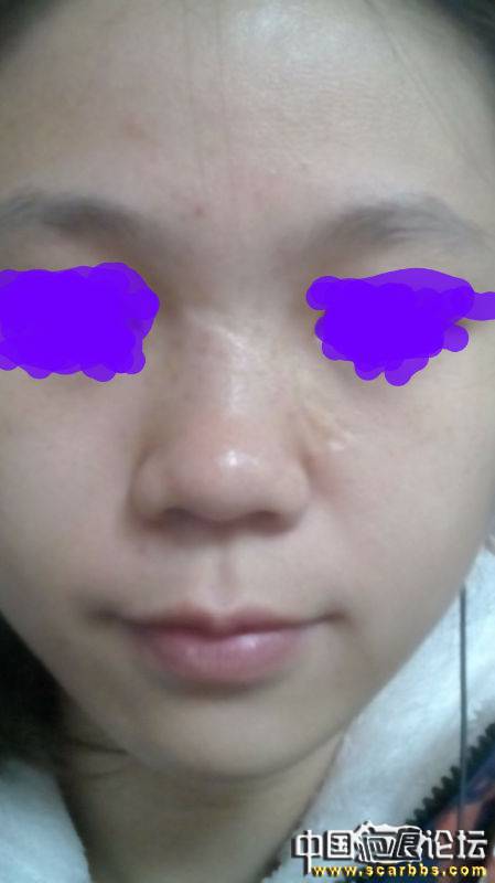 疤痕削磨手术后（不知是好是坏） 