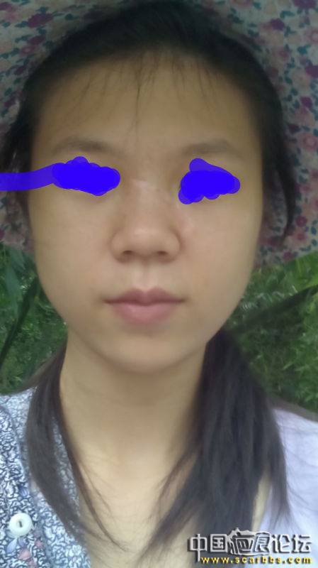 疤痕削磨手术后（不知是好是坏） 