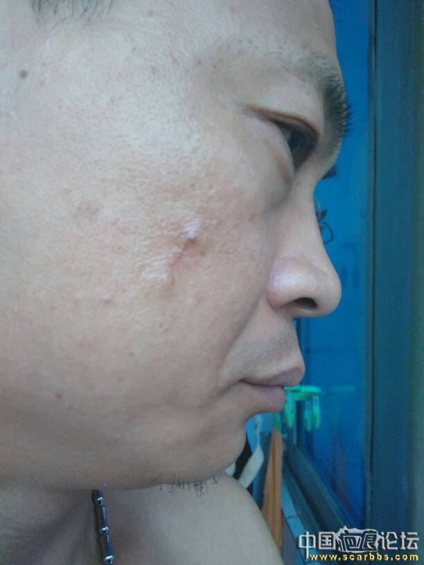 手术去痣留一厘米长两头猫耳朵，一切交给上帝吧