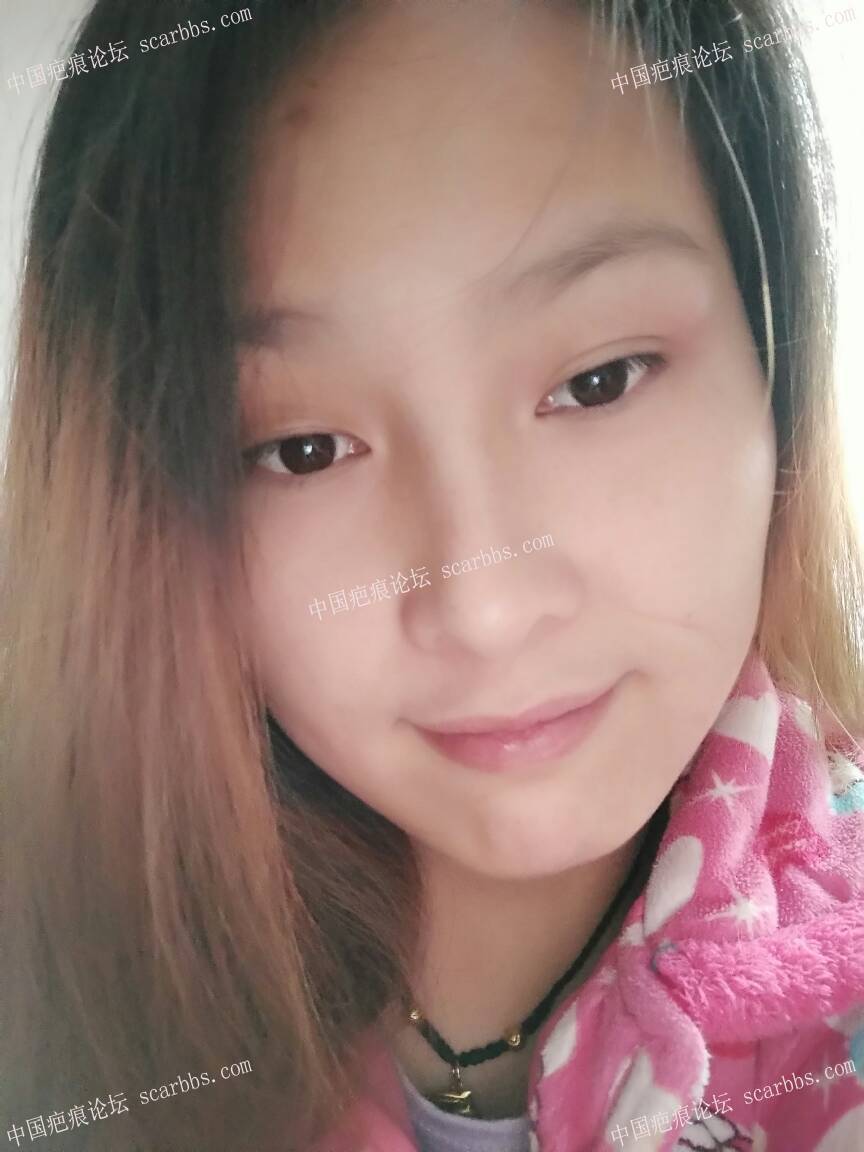 虽然有了疤，但是我依然健康快乐开心。
