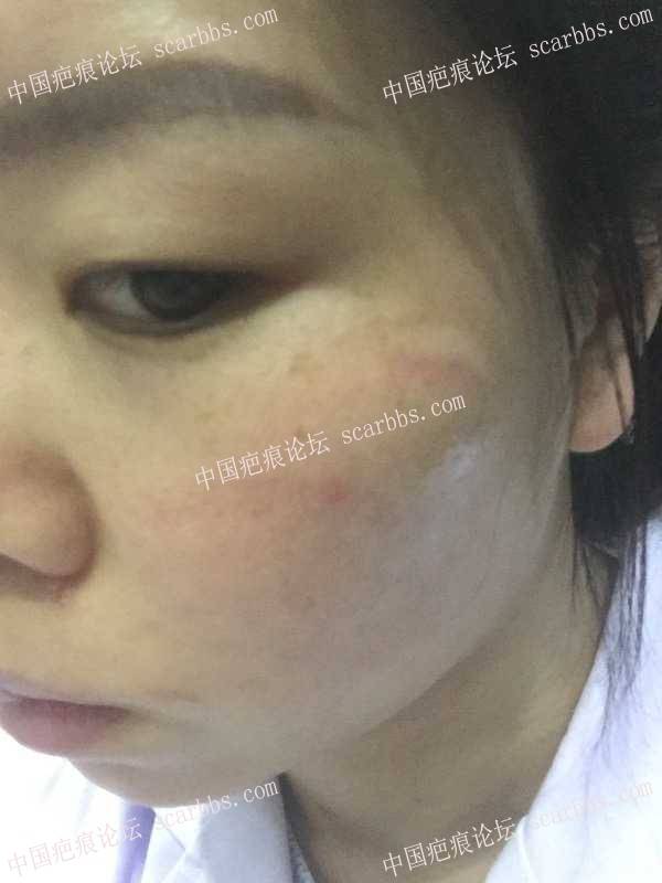 脸部18年1月13号被人抓伤，现在已经结痂，有粗线条凹陷疤，求专家指点迷津。 