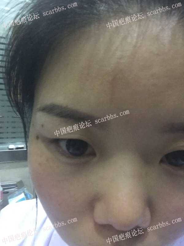 脸部18年1月13号被人抓伤，现在已经结痂，有粗线条凹陷疤，求专家指点迷津。 