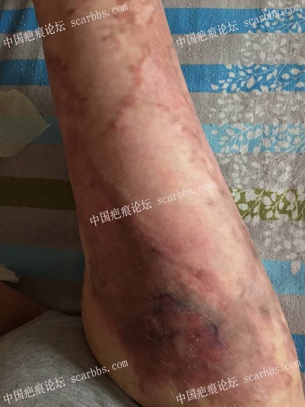 烧伤近一年时间，煤气漏气烧伤70%面积，双下肢较严重，希望疤友给点治疗建议 