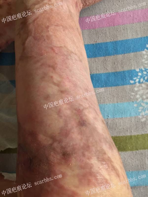 烧伤近一年时间，煤气漏气烧伤70%面积，双下肢较严重，希望疤友给点治疗建议 