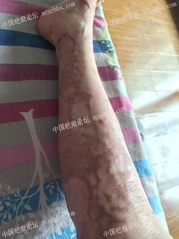 烧伤近一年时间，煤气漏气烧伤70%面积，双下肢较严重，希望疤友给点治疗建议 