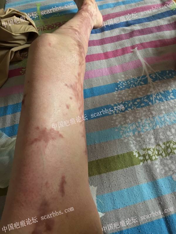 烧伤近一年时间，煤气漏气烧伤70%面积，双下肢较严重，希望疤友给点治疗建议 