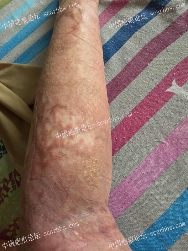 烧伤近一年时间，煤气漏气烧伤70%面积，双下肢较严重，希望疤友给点治疗建议 