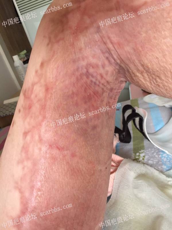 烧伤近一年时间，煤气漏气烧伤70%面积，双下肢较严重，希望疤友给点治疗建议 