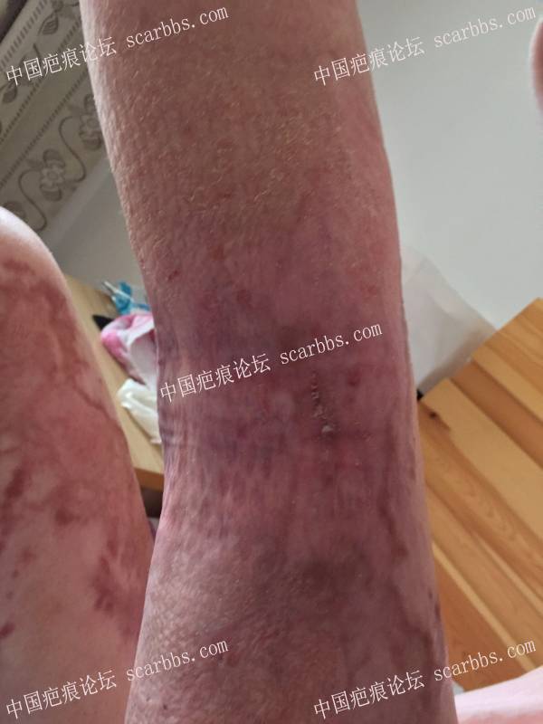 烧伤近一年时间，煤气漏气烧伤70%面积，双下肢较严重，希望疤友给点治疗建议 