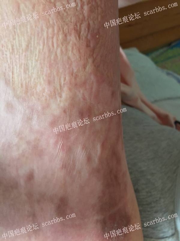 烧伤近一年时间，煤气漏气烧伤70%面积，双下肢较严重，希望疤友给点治疗建议 