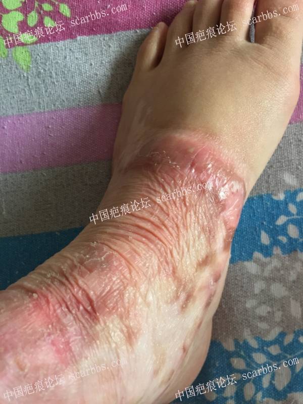 烧伤近一年时间，煤气漏气烧伤70%面积，双下肢较严重，希望疤友给点治疗建议 