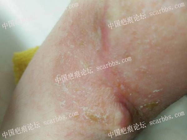 右手臂烫伤疤痕：上海NO.9治疗+最真实的分享+全过程记录+亲身体验 