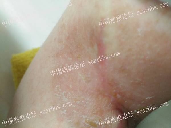 右手臂烫伤疤痕：上海NO.9治疗+最真实的分享+全过程记录+亲身体验 