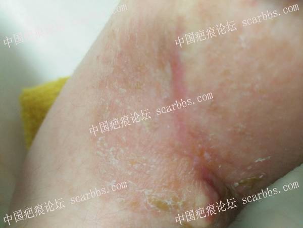 右手臂烫伤疤痕：上海NO.9治疗+最真实的分享+全过程记录+亲身体验 