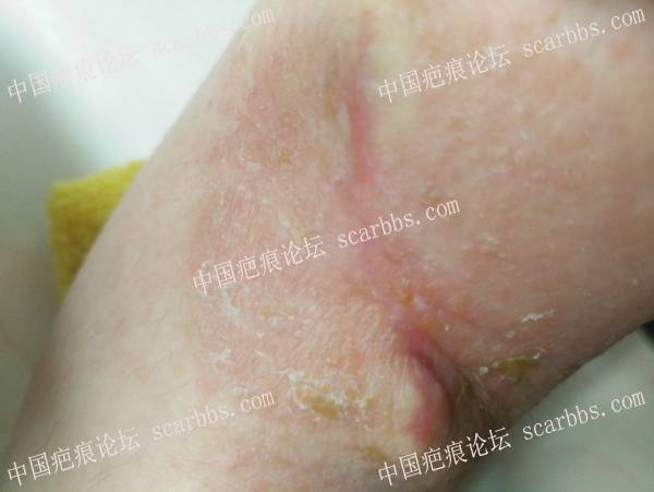 右手臂烫伤疤痕：上海NO.9治疗+最真实的分享+全过程记录+亲身体验 