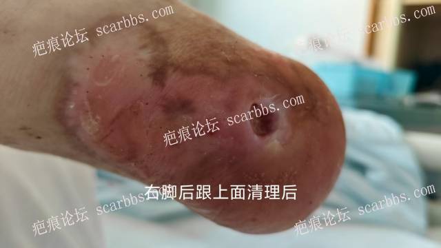 2025年李高令接治2023年低温烫伤的老人（青岛） 