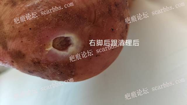 2025年李高令接治2023年低温烫伤的老人（青岛） 