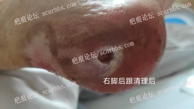 2025年李高令接治2023年低温烫伤的老人（青岛） 