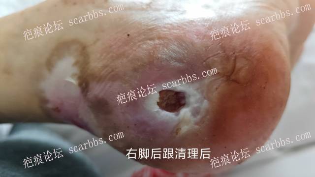 2025年李高令接治2023年低温烫伤的老人（青岛） 