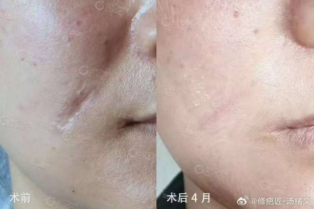 面部凹陷性疤痕切除缝合术后4月