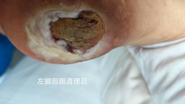 2025年李高令接治2023年低温烫伤的老人（青岛） 