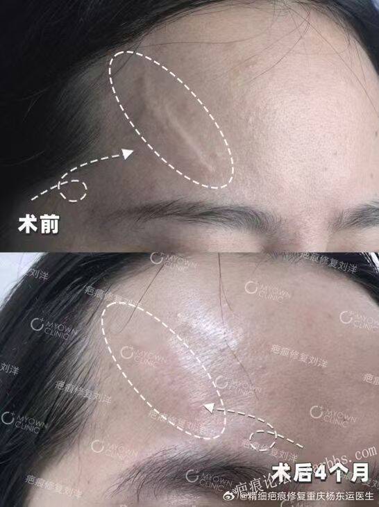【额部疤痕】修复案例来咯