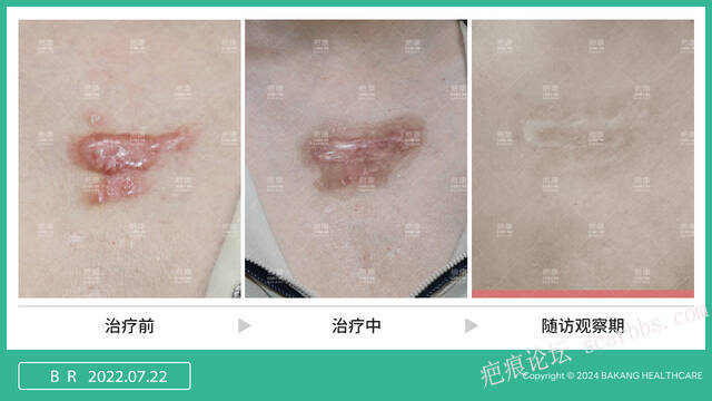 疤痕疙瘩修复3重底层逻辑 