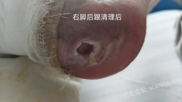 2025年李高令接治2023年低温烫伤的老人（青岛） 