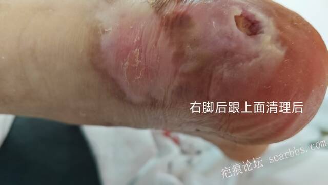 2025年李高令接治2023年低温烫伤的老人（青岛） 