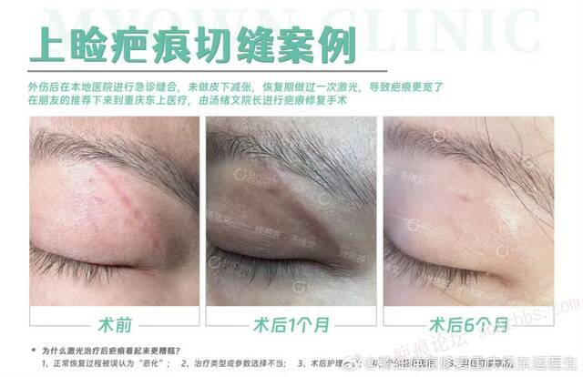 眼部疤痕