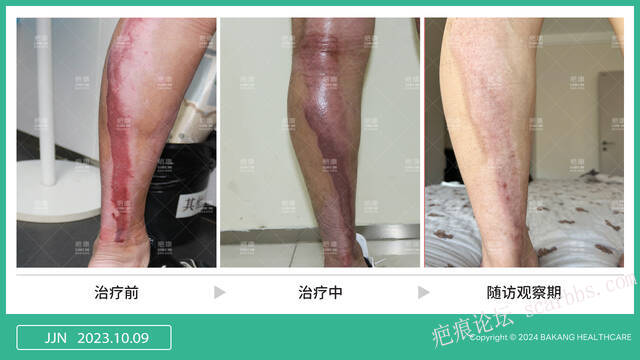 烧烫伤后不疼≠没事 警惕疤痕风险