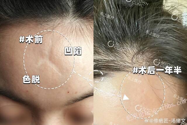 额部疤痕切除缝合术后一年半