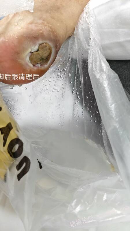2025年李高令接治2023年低温烫伤的老人（青岛） 