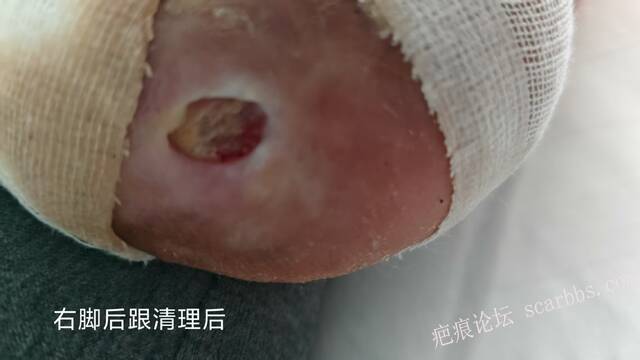 2025年李高令接治2023年低温烫伤的老人（青岛） 