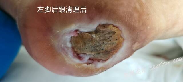 2025年李高令接治2023年低温烫伤的老人（青岛） 