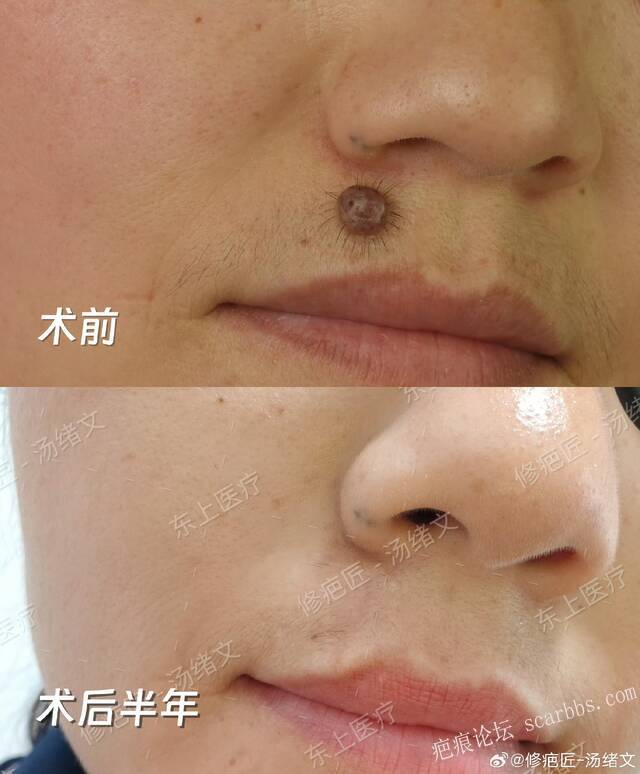 上唇黑毛痣切除缝合术后半年