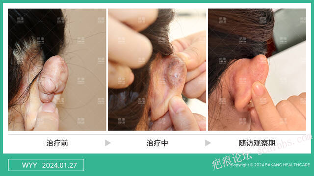 同位素 vs 浅放？疤痕疙瘩选错=白治 