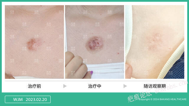 同位素 vs 浅放？疤痕疙瘩选错=白治 