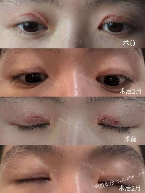 眼部疤痕修复