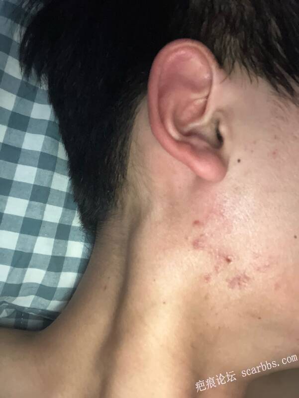 腮部疤痕，求助求助 