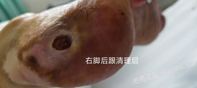 2025年李高令接治2023年低温烫伤的老人（青岛） 