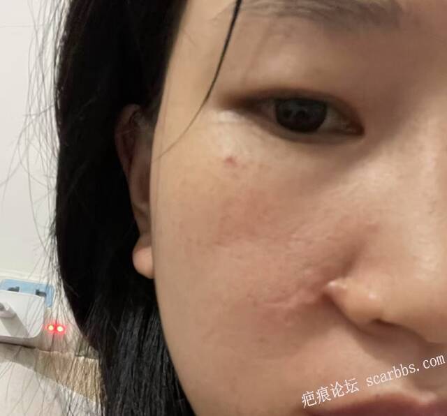 脸部凹陷疤痕，祛疤求助