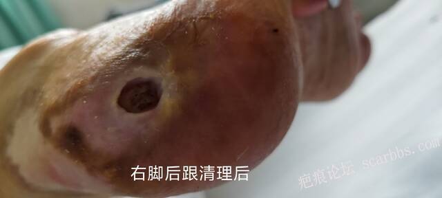 2025年李高令接治2023年低温烫伤的老人（青岛） 